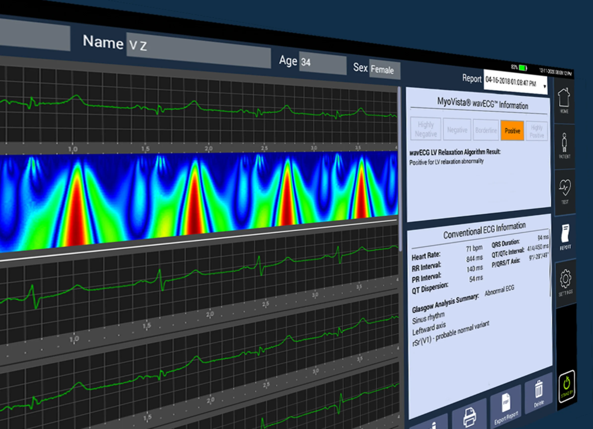 MyoVista® Insights™ - High-Fidelity ECG Signal Analysis